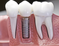 3D model of dental implant in gums Concord, NC